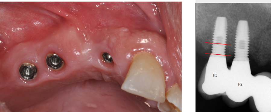 Tand med implantat - SKRI bild 3